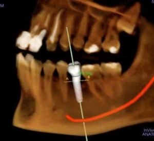3D CBCT scan for dental implant planning in Gurgaon