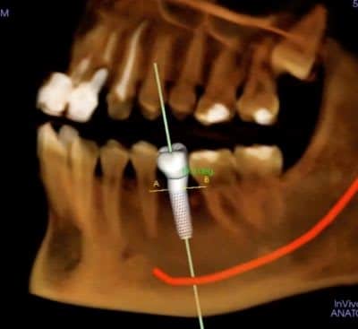 3D CBCT scan for dental implant planning in Gurgaon