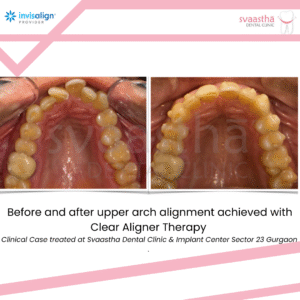 Before and after upper arch alignment achieved with clear aligner treatment at Svaastha Dental Clinic in Sector 23 Gurgaon
