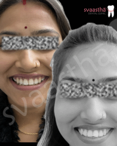 Before and after orthodontic treatment showing improved teeth alignment at Svaastha Dental Clinic