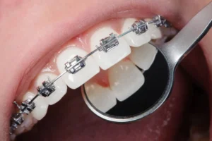 Traditional metal braces used to straighten teeth
