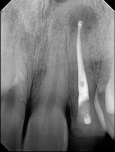 x-ray image showing RCT Filling