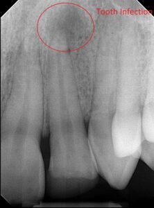 xray image showing infection in tooth root