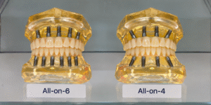 Comparison of All-on-4 and All-on-6 full-mouth dental implant concepts