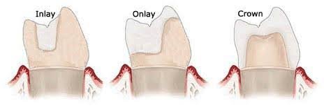 varieties of final restoration after RCT 
