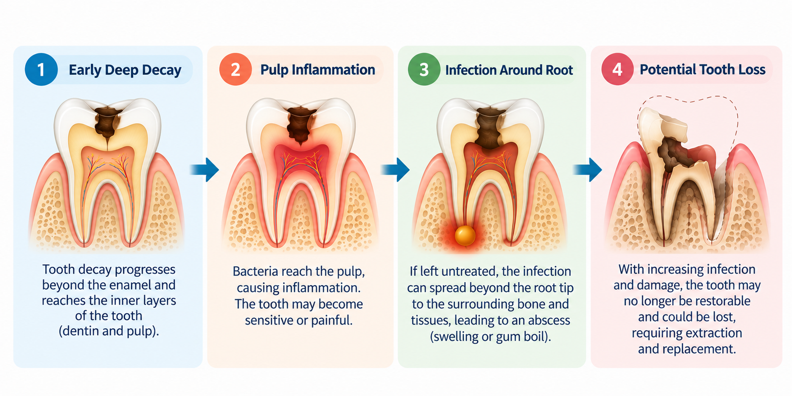 how tooth cavity can progress if left untreated